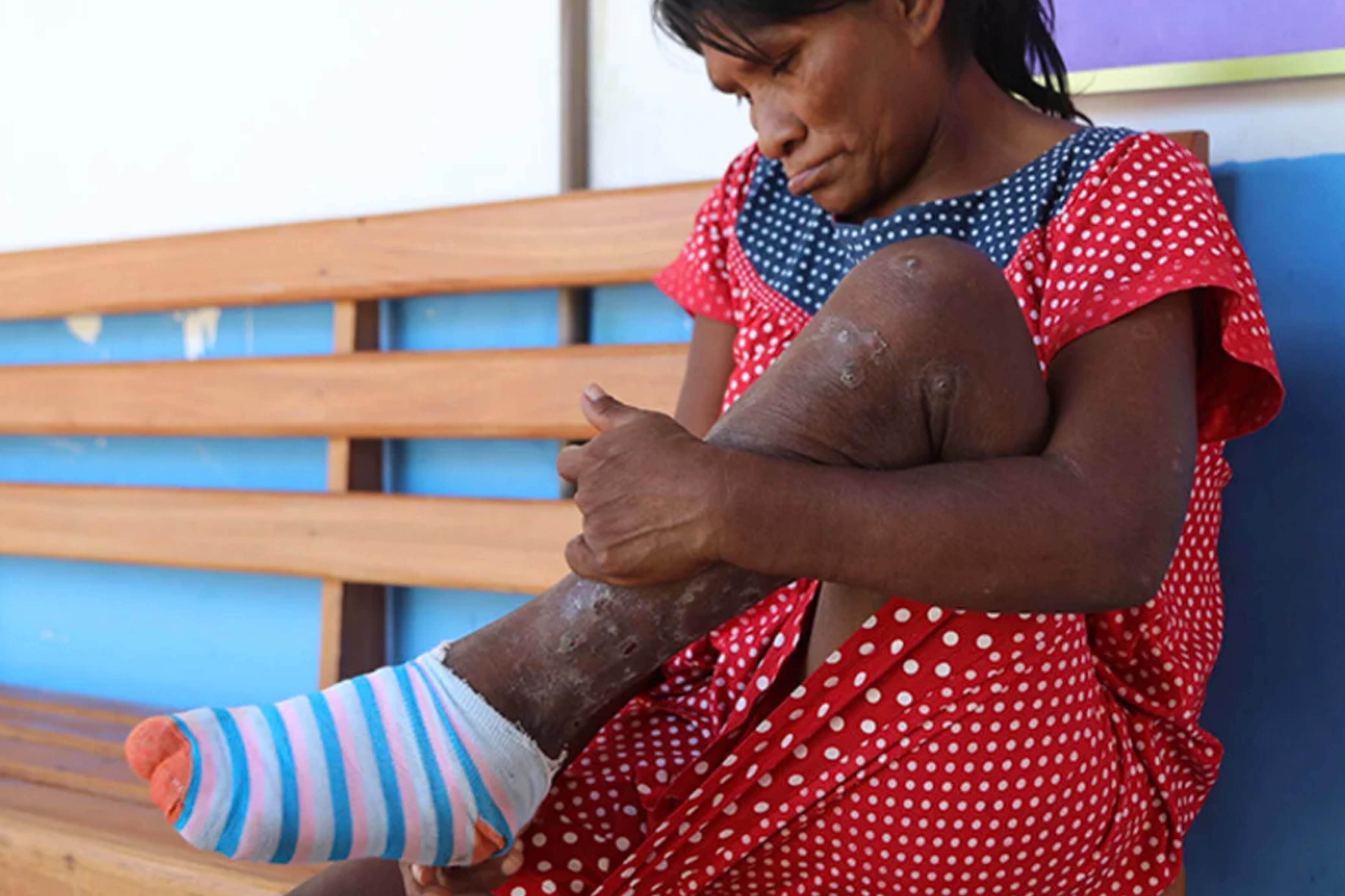 Tungiasis and the guardians of the Amazon